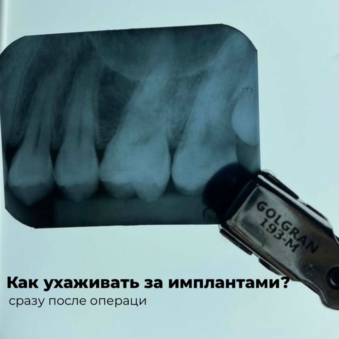 Уход за имплантатами после операции: секреты успешной реабилитации